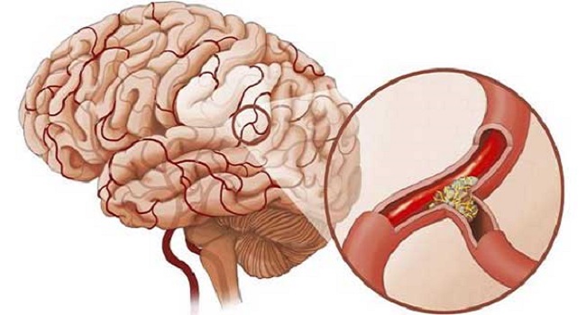 Tai biến mạch máu não là bệnh gì?