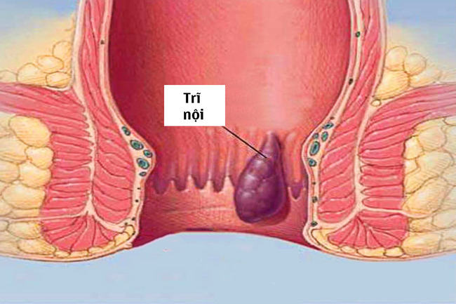 Bệnh trĩ nội