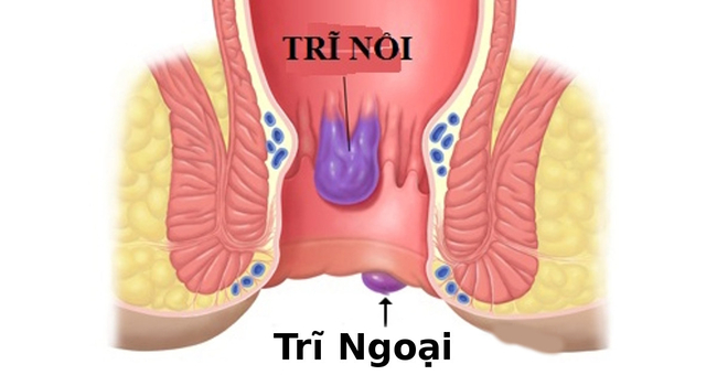 Trĩ nội - Trĩ ngoại là gì?