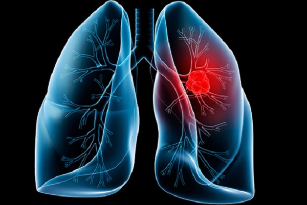 Bệnh ung thư phổi có chữa được không?